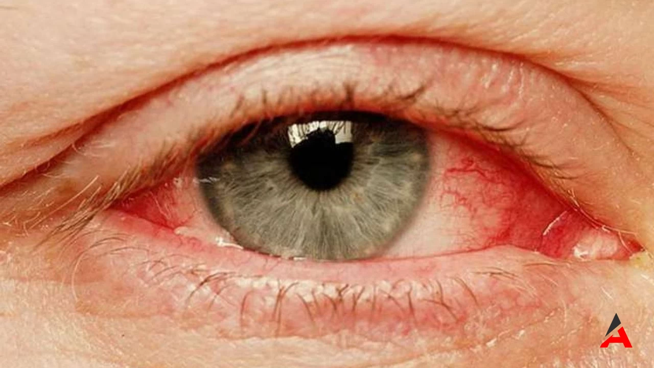 Göz Yanması Nedenleri, Belirtileri Ve Tedavisi2