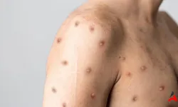 Mpox (Maymun Çiçeği) Virüsü Nedir?