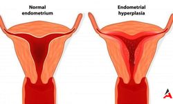 Rahim Duvarı Neden Kalınlaşır? Hormonal Dengesizlikler ve Obezite Riskleri!