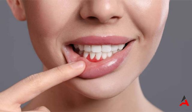 Diş Eti Şişliği: Nedenleri ve Önleme Yöntemleri