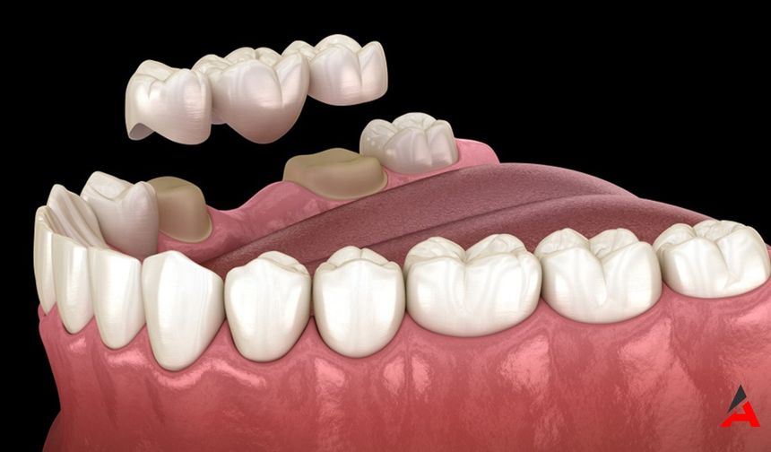 Diş Köprüsü Uygulaması: Eksik Dişler İçin Estetik ve Fonksiyonel Çözüm